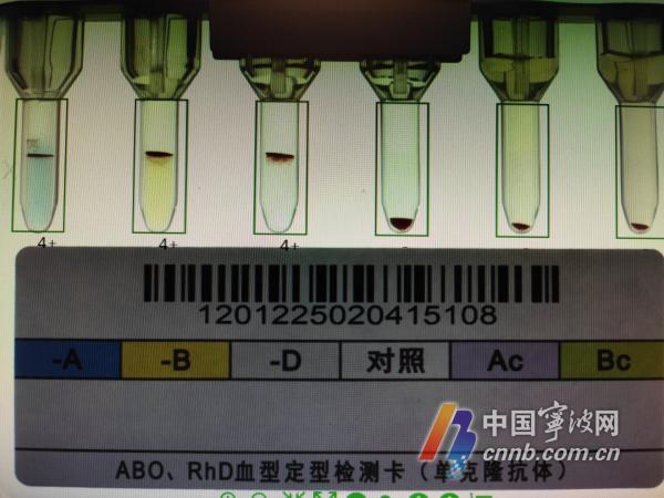 常见方法
:血型也可能“骗”人 宁波一对AB型和O型的父母生下了AB型的孩子