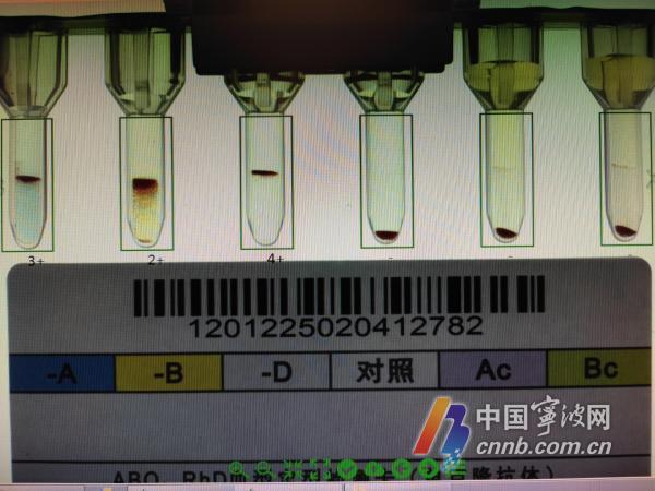 常见方法
:血型也可能“骗”人 宁波一对AB型和O型的父母生下了AB型的孩子