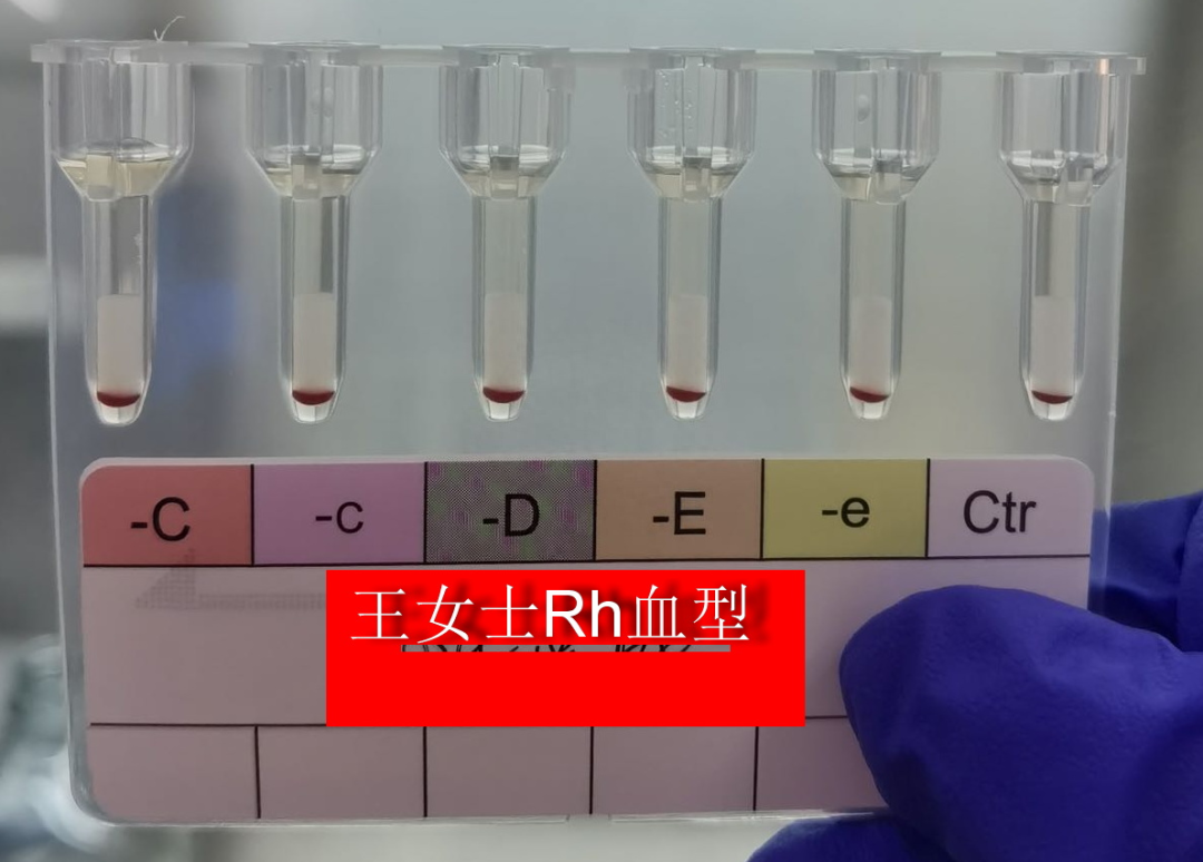 揭露真相
:六百万分之一的机会！全球黄金血型不足50例，台州连续发现2例