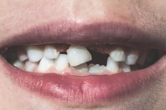 揭秘
:已婚女人梦见掉牙是什么意思？