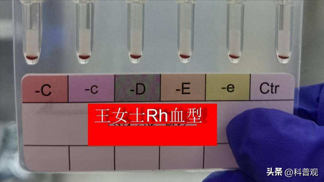 工作反思
:全球不足50例？江苏发现2例罕见黄金血型，比熊猫血更珍贵