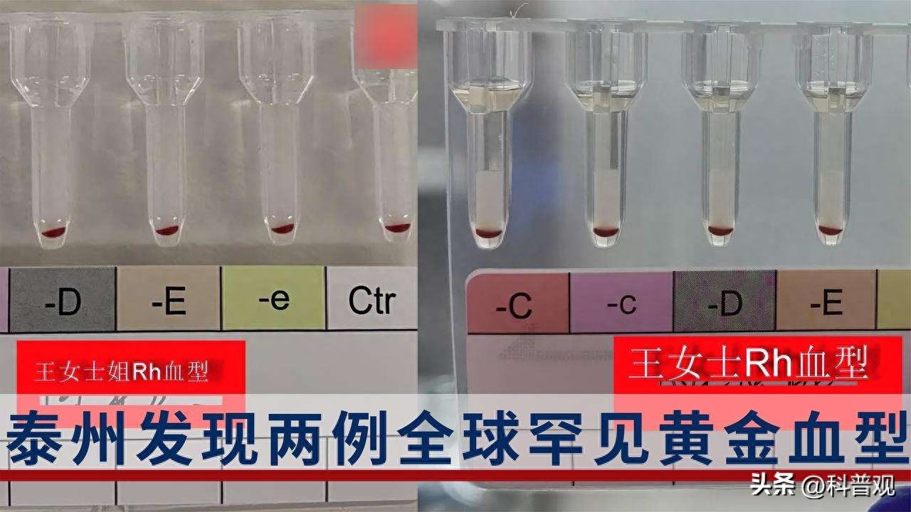 工作反思
:全球不足50例？江苏发现2例罕见黄金血型，比熊猫血更珍贵